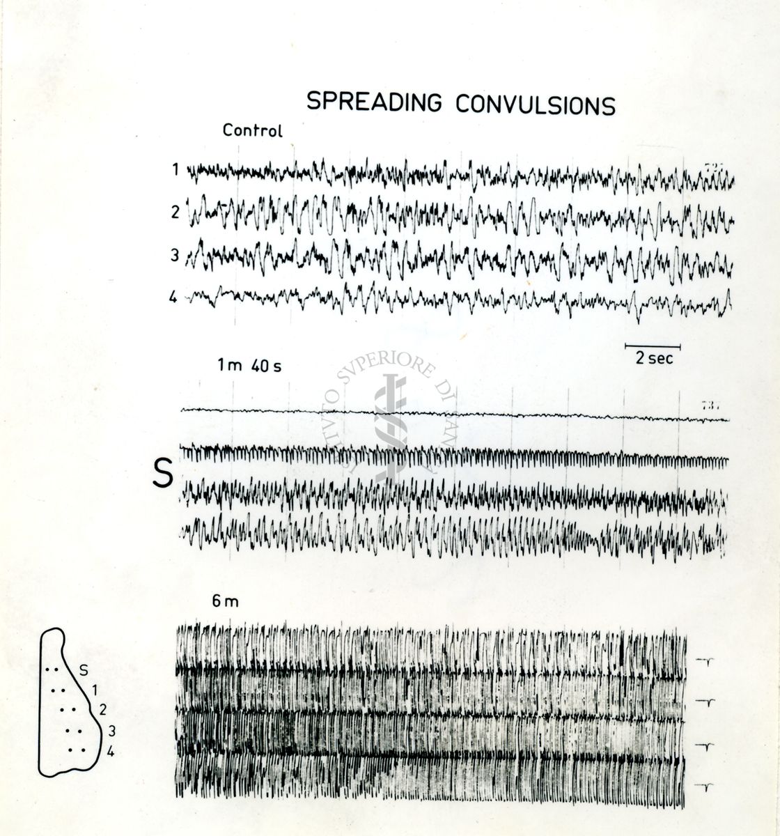 Immagine che ritrae l'andamento dell' EEG