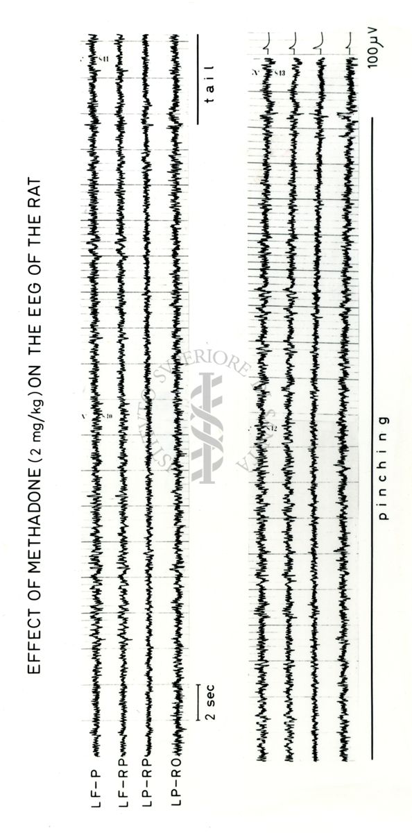 Tracciati elettroencefalografici