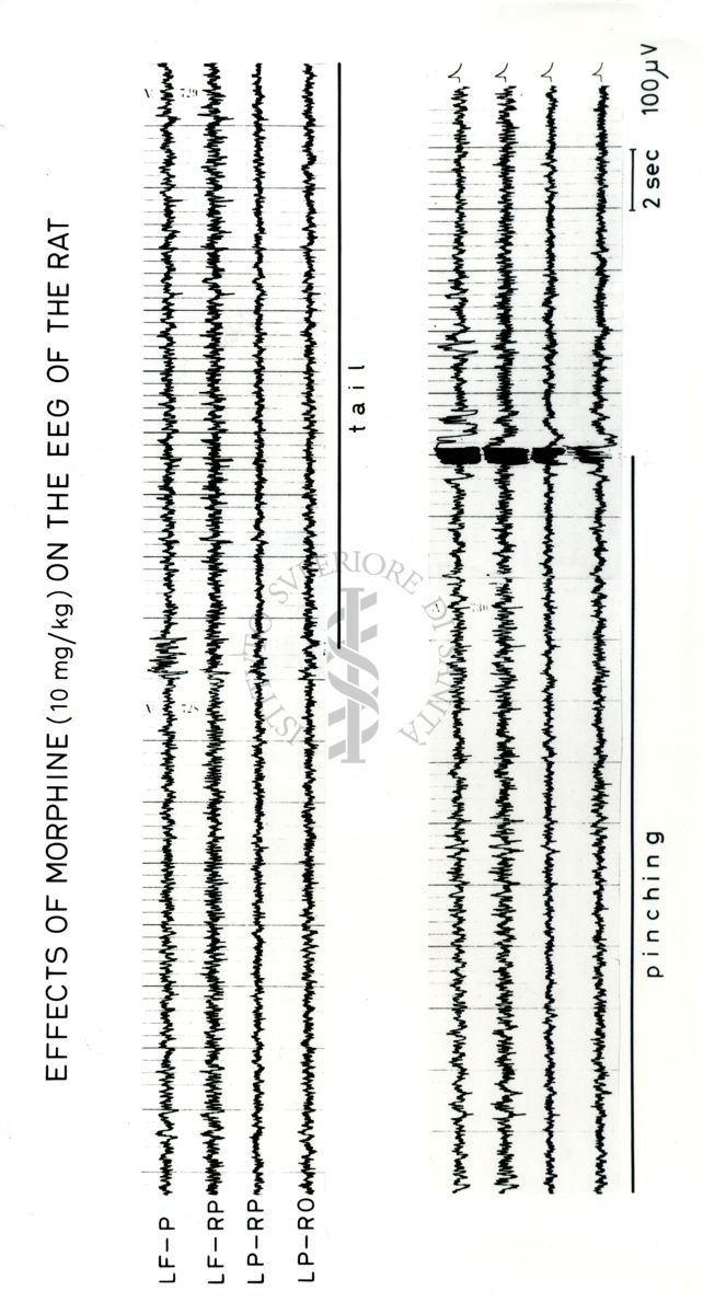 Tracciati elettroencefalografici