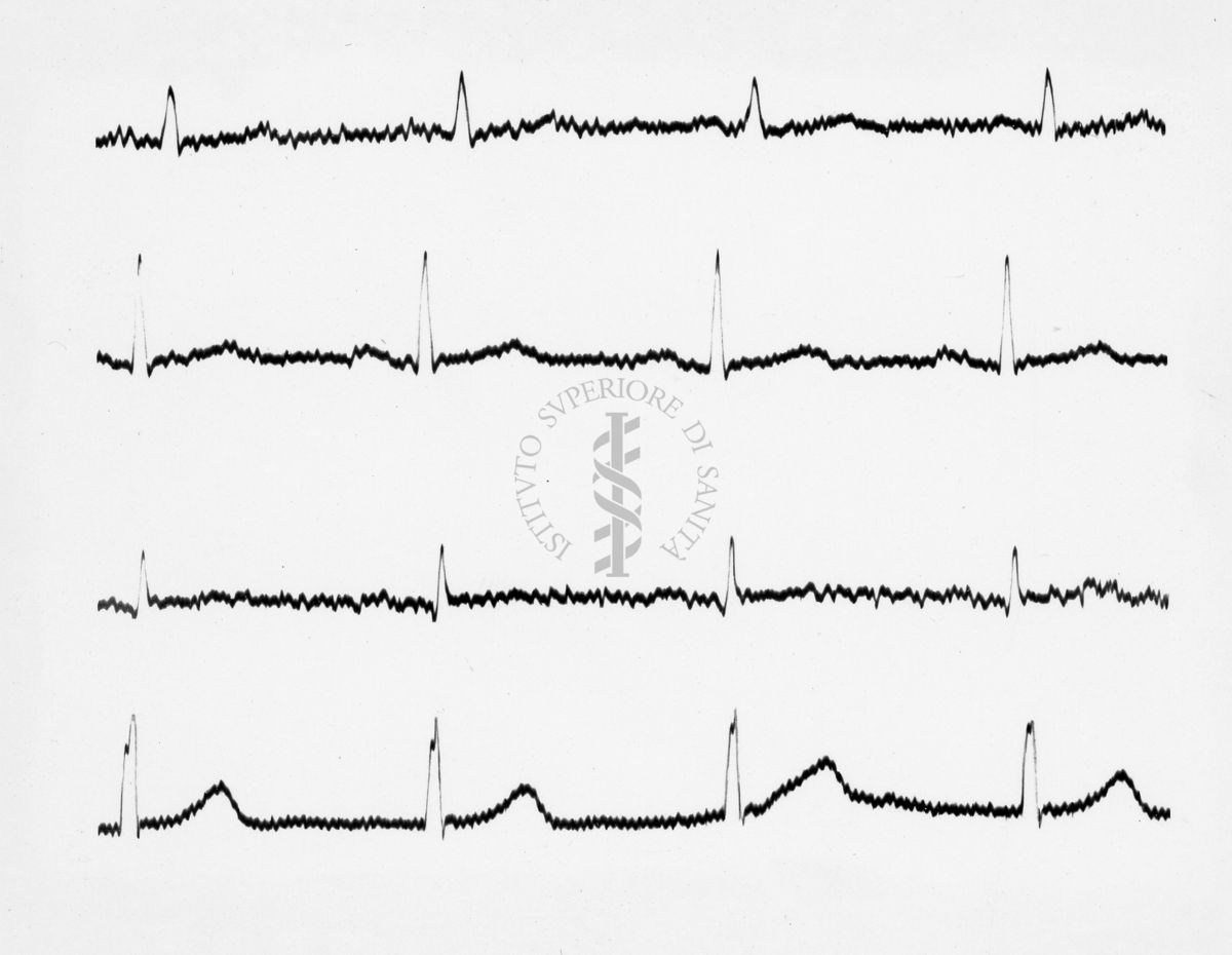 Reperti elettrocardiografici nelle artropatie croniche