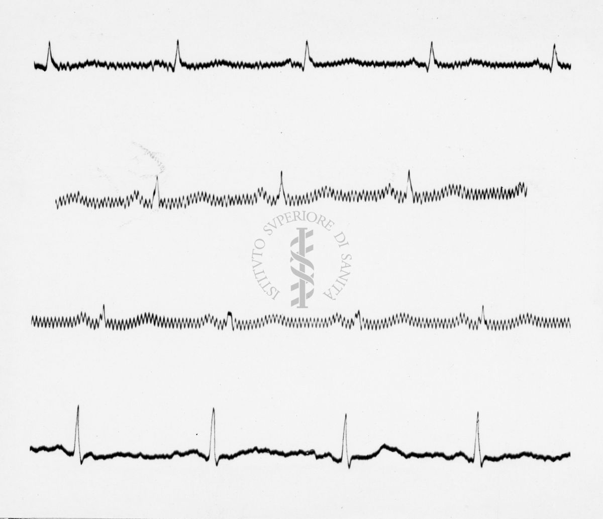 Reperti elettrocardiografici nelle artropatie croniche