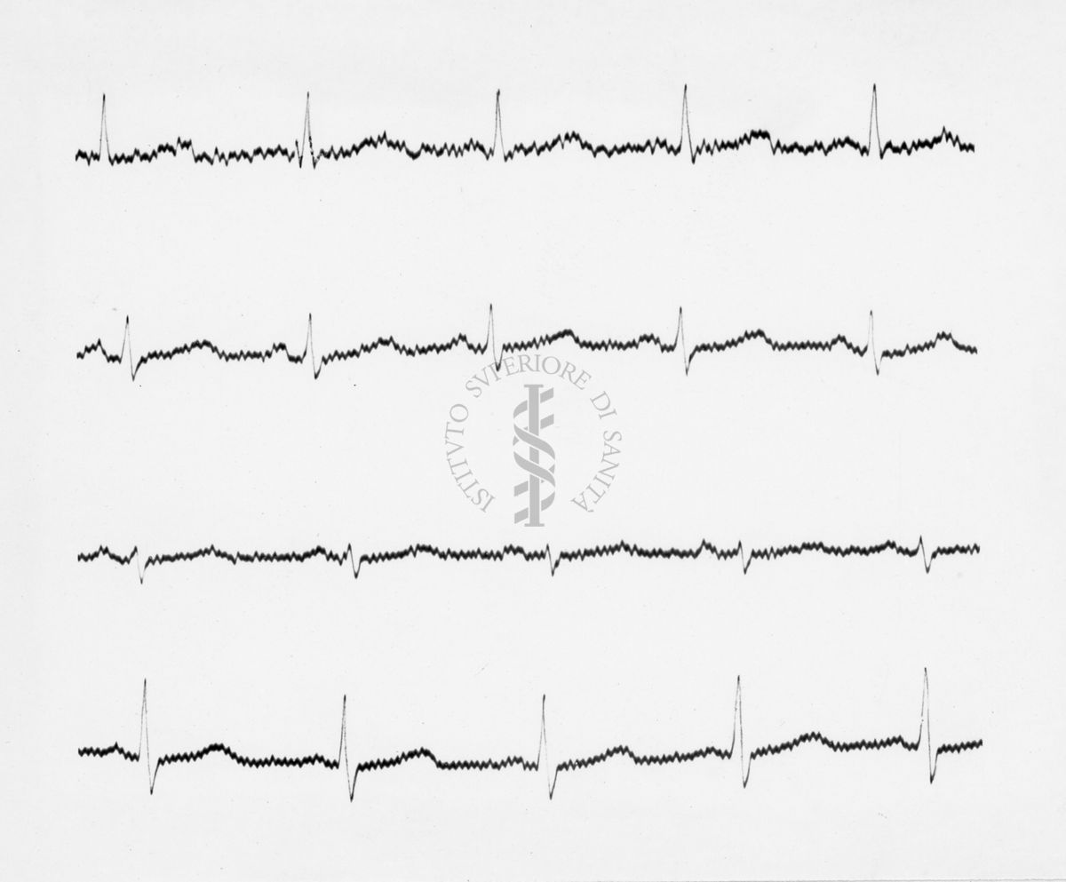 Reperti elettrocardiografici nelle artropatie croniche