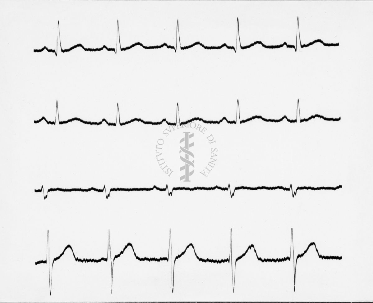 Reperti elettrocardiografici nelle artropatie croniche