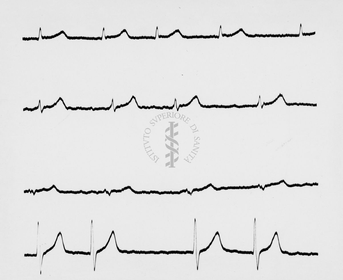 Reperti elettrocardiografici nelle artropatie croniche