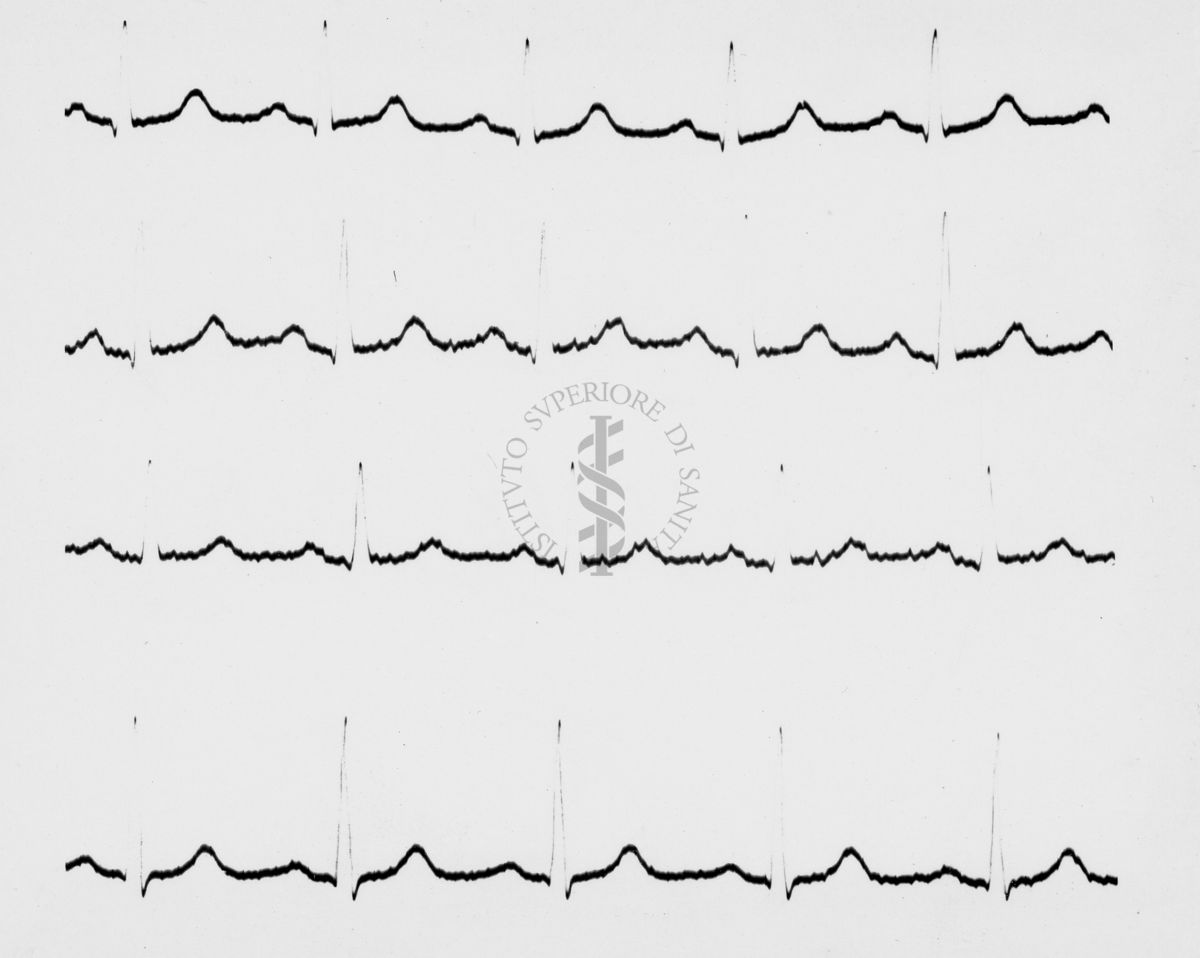 Reperti elettrocardiografici nelle artropatie croniche