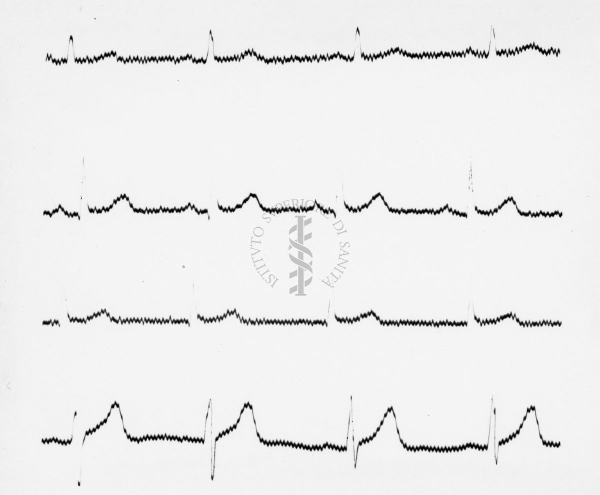 Reperti elettrocardiografici nelle artropatie croniche