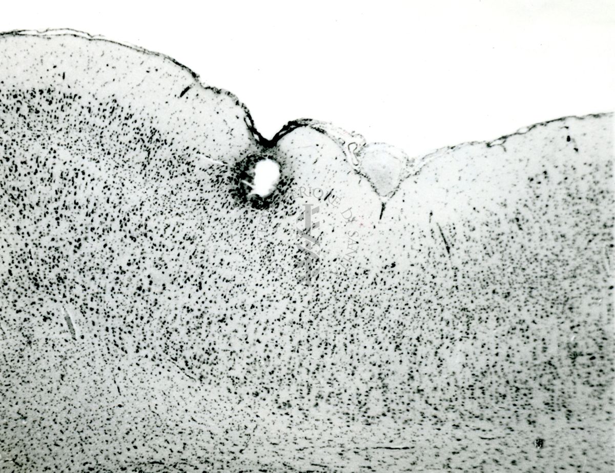 Sezione di un'area cerebrale recante lesione dopo inoculazione di farmaci mediante cannula con l'uso dello stereotassico