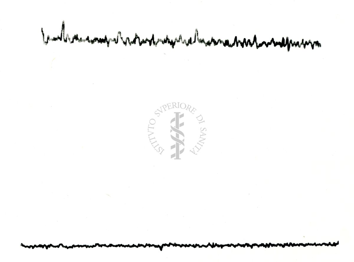 Possibili tracciati EEG