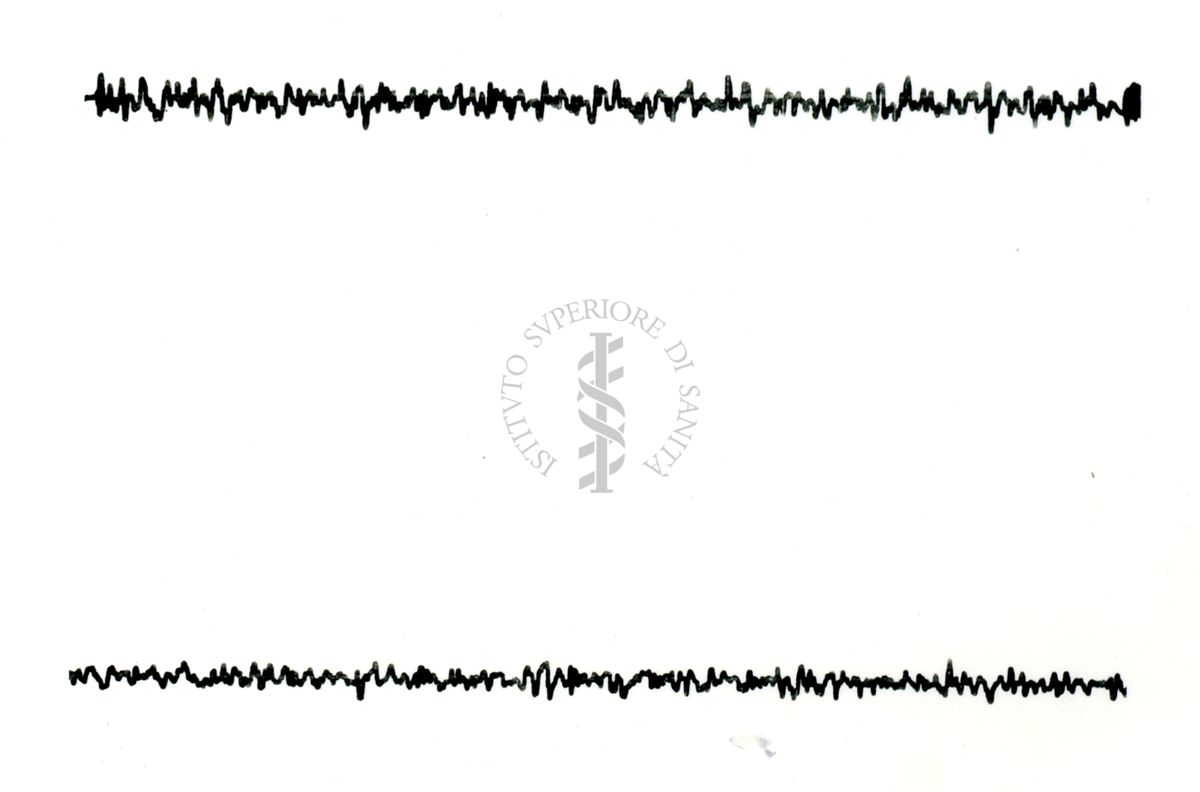 Possibili tracciati EEG