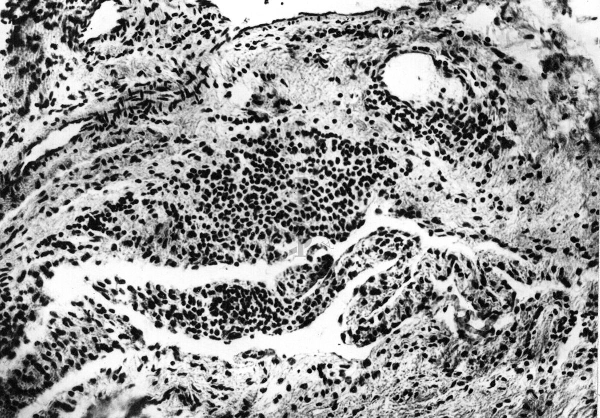 Artrite reumatoide nella lussazione della spalla