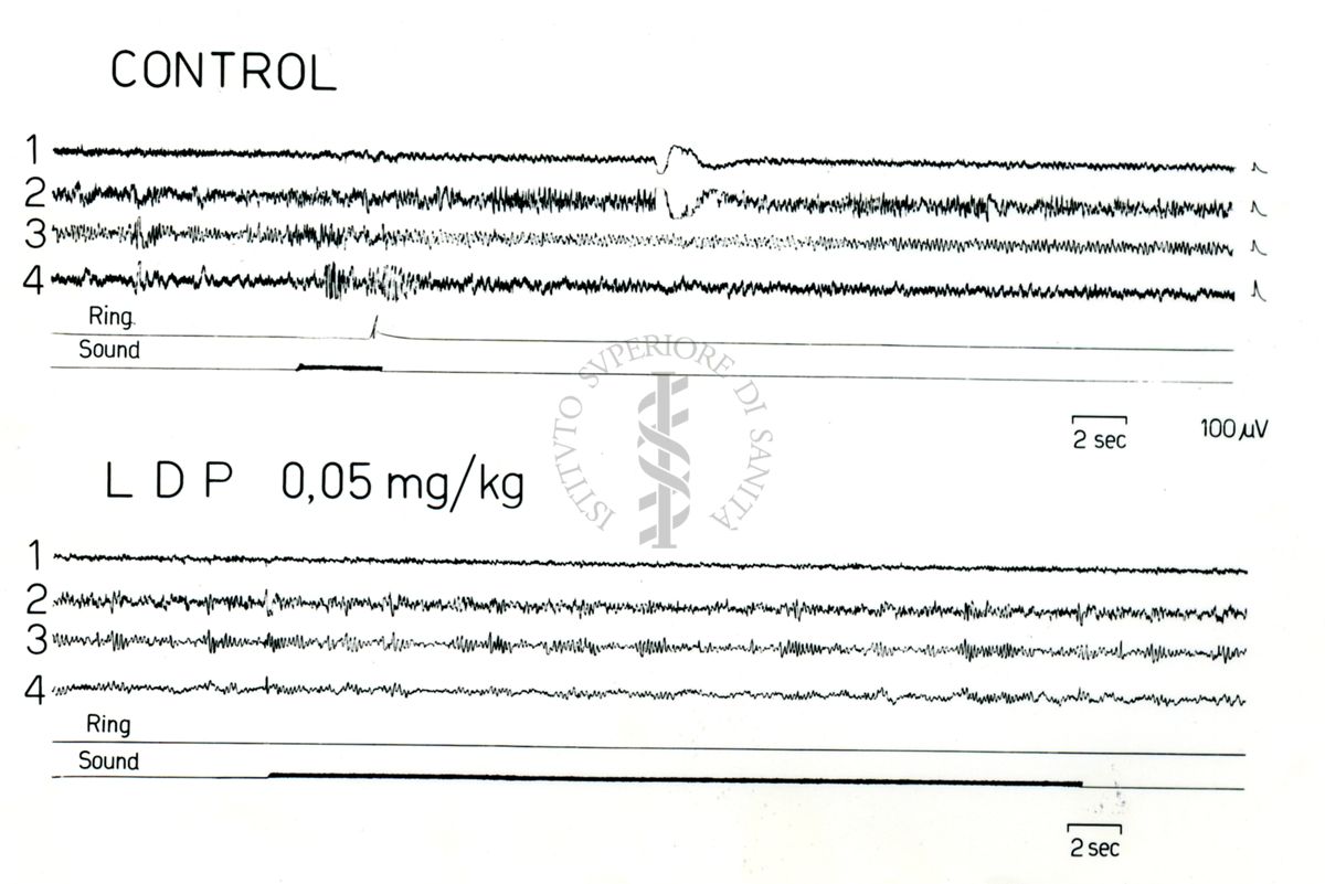 Possibili tracciati EEG