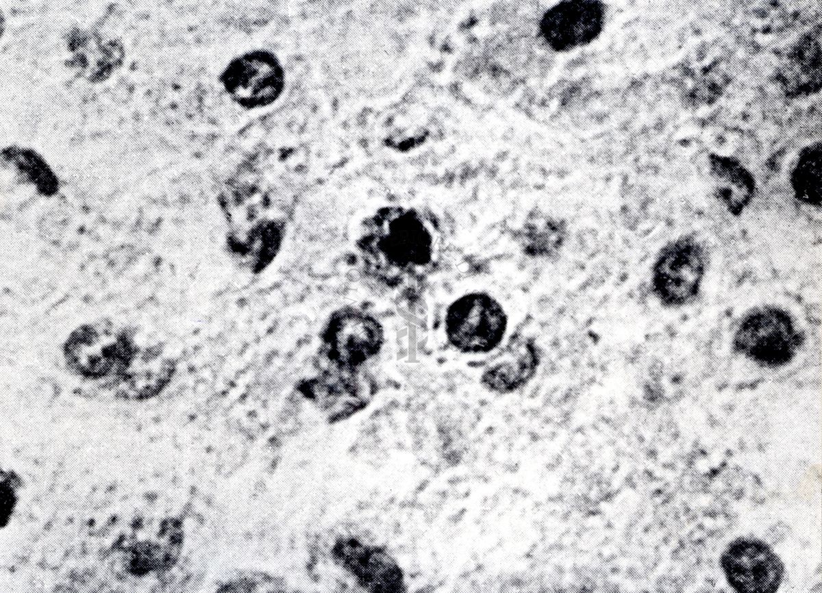 Provocazione sperimentale della flogosi iperergica produttivo-sclerotica (fegato)