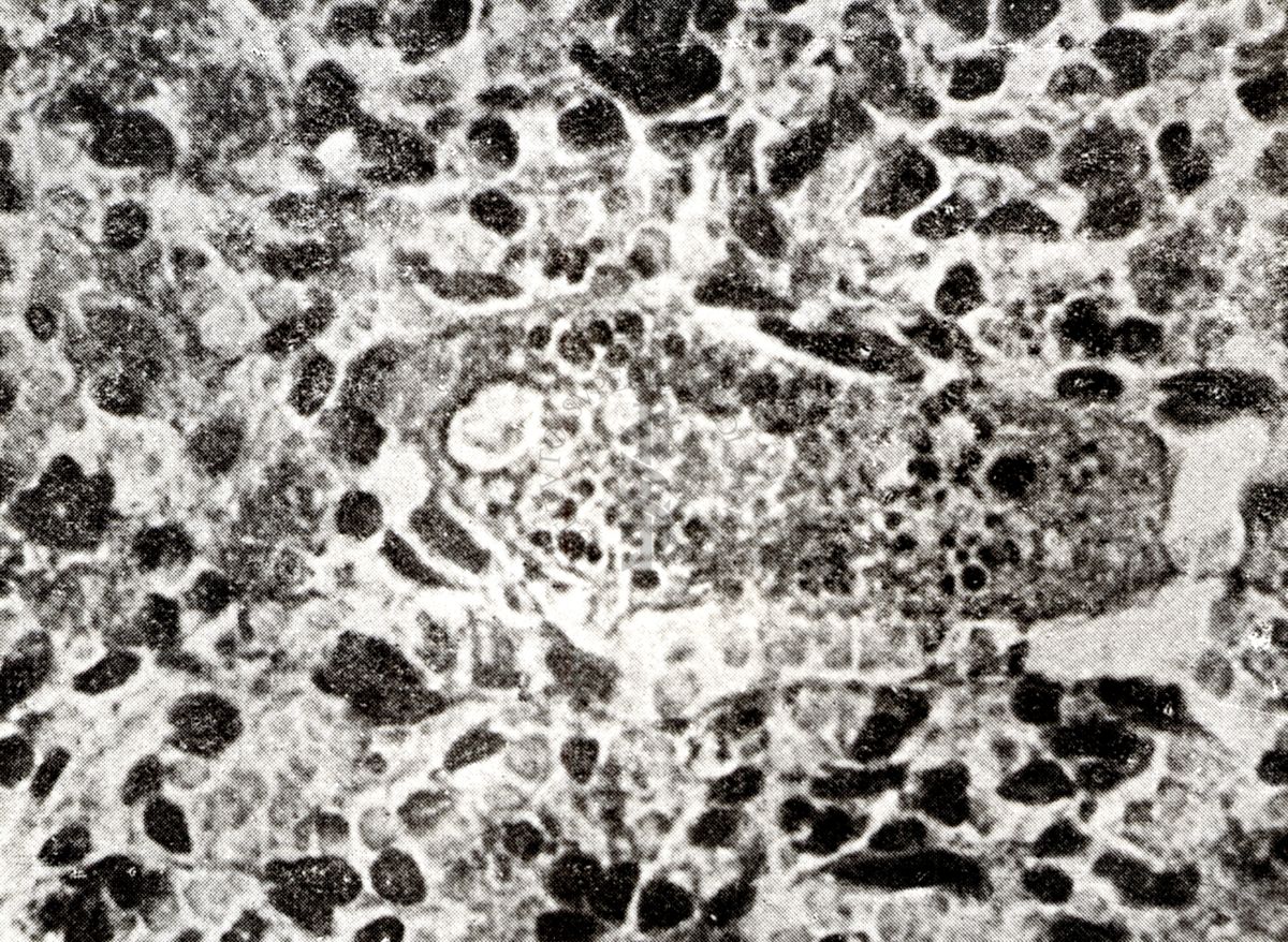 Provocazione sperimentale della flogosi iperergica produttivo-sclerotica (milza)