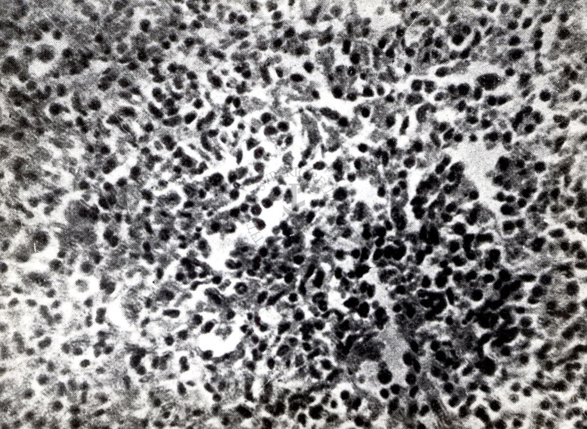 Provocazione sperimentale della flogosi iperergica produttivo-sclerotica (milza)