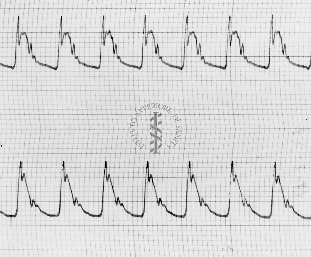 Sfigmogrammi sull'apertura e chiusura dei vasi sanguigni