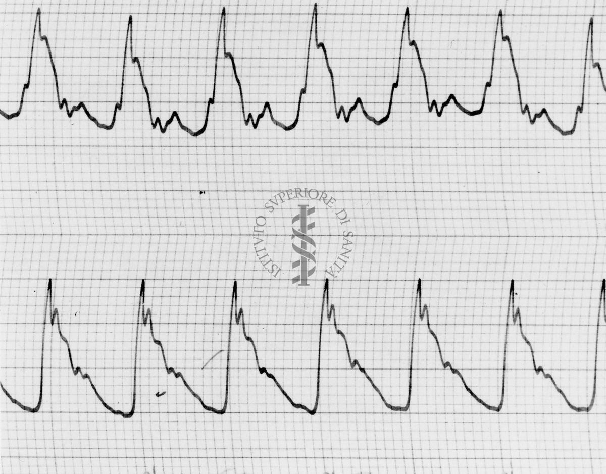 Sfigmogrammi sull'apertura e chiusura dei vasi sanguigni