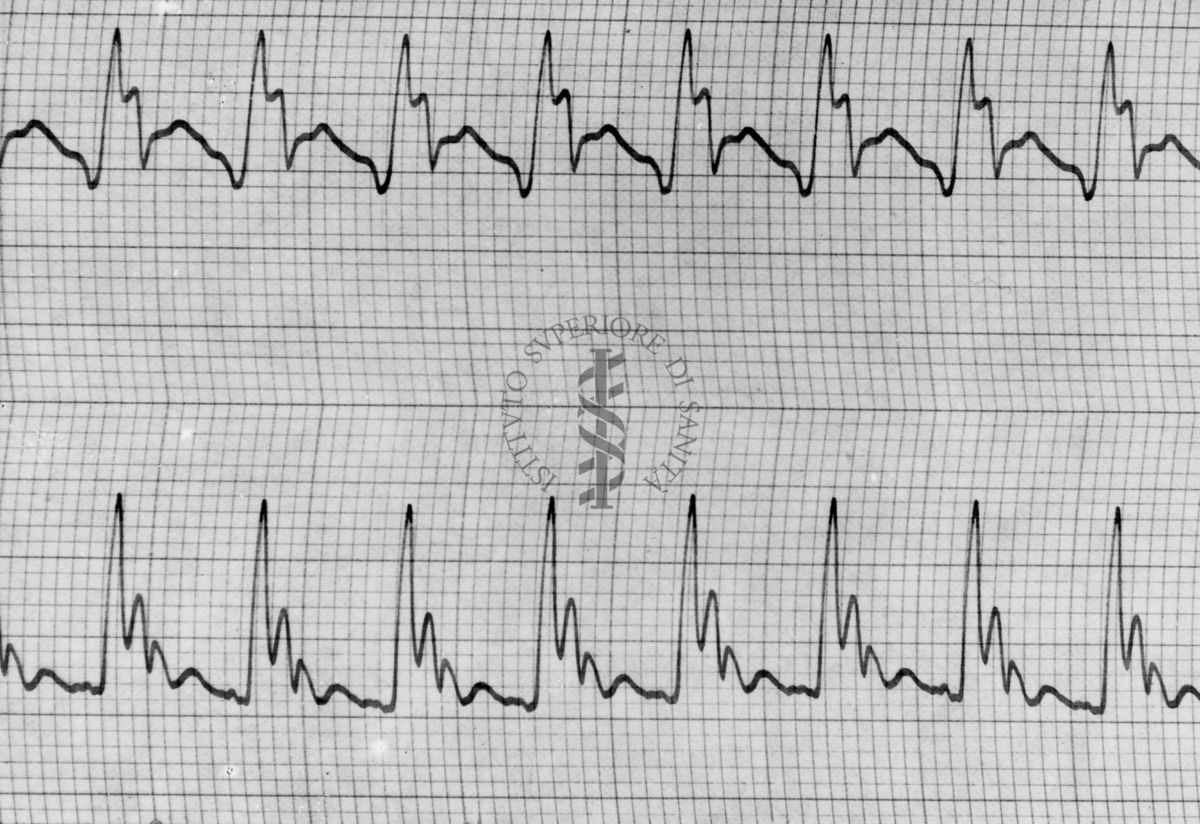 Sfigmogrammi sull'apertura e chiusura dei vasi sanguigni