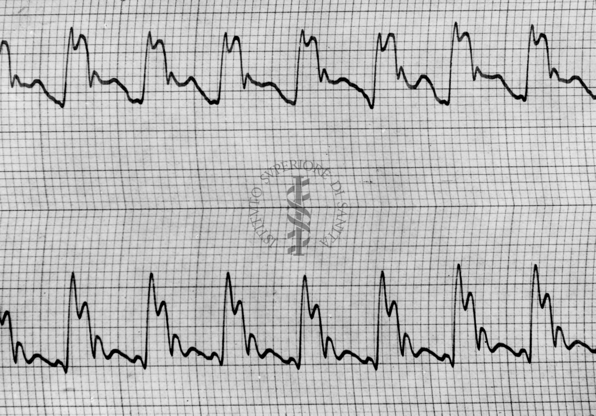 Sfigmogrammi sull'apertura e chiusura dei vasi sanguigni