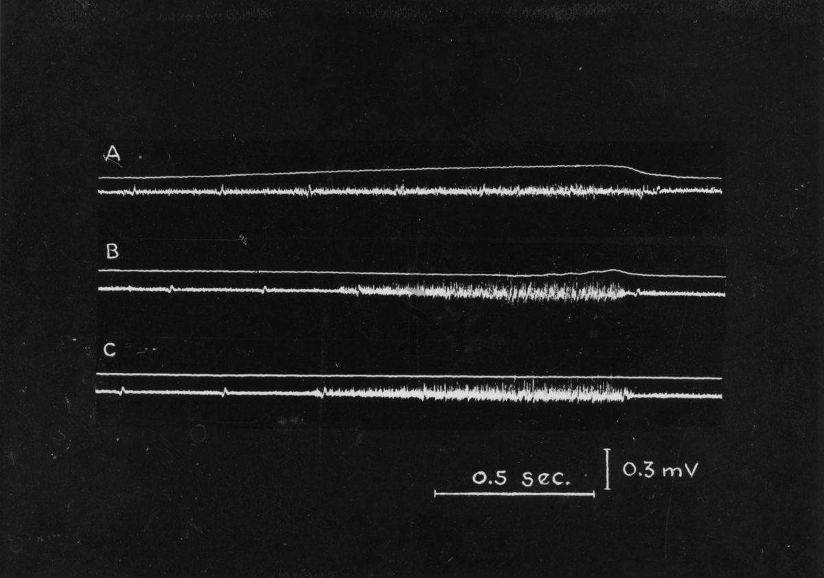 Neurogrammi del frenico