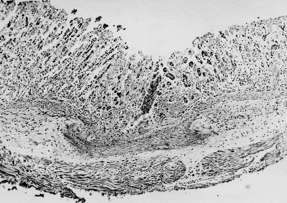 Ulcera sperimentale da istamina nella cavia (fotografie in serie) - micro fotografia originale 200 ingr.