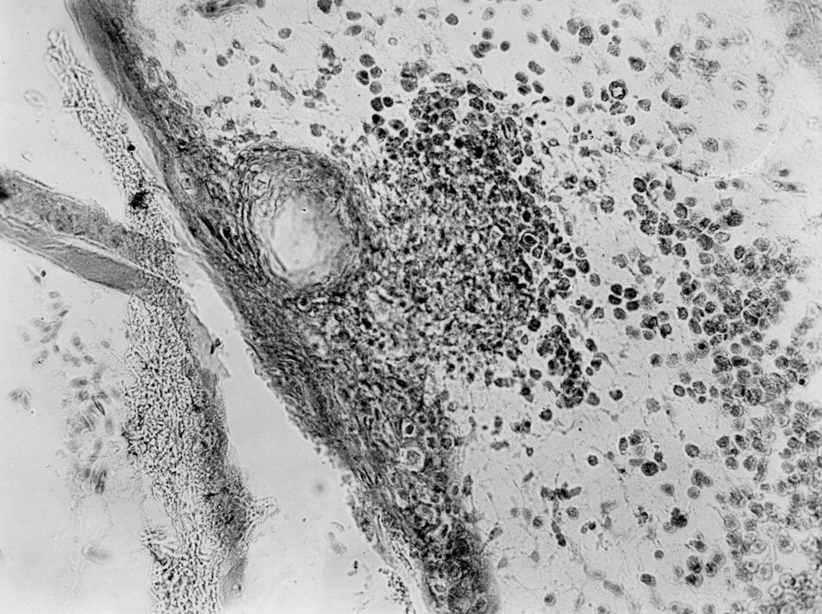 Tubercolosi aviaria sulla membrana corion allantoidea dei polli - micro fotografia originale 320 ingr.