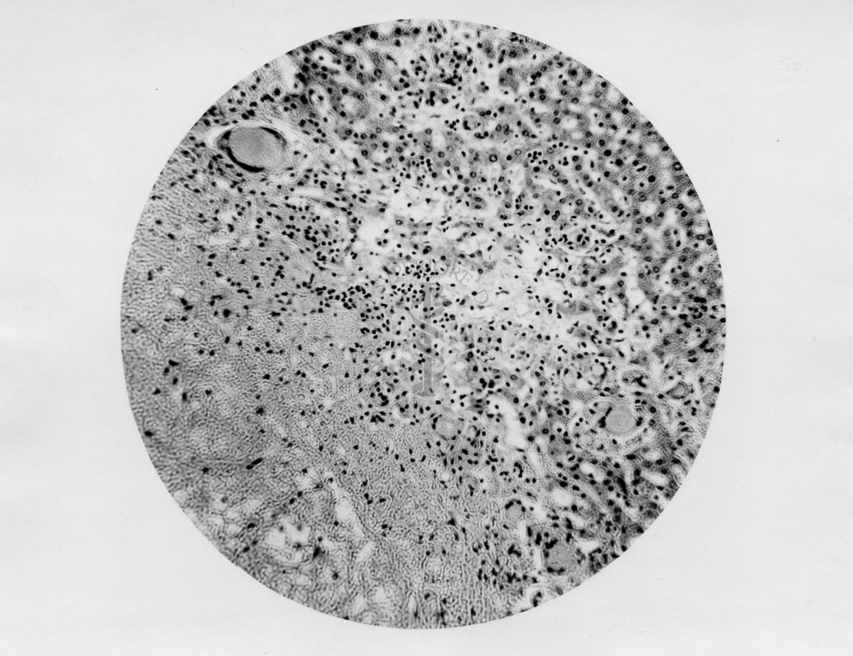 Micobatteri (Battaglini) Fegato-margini di zona caseosa con cellule giganti - micro fotografia originale