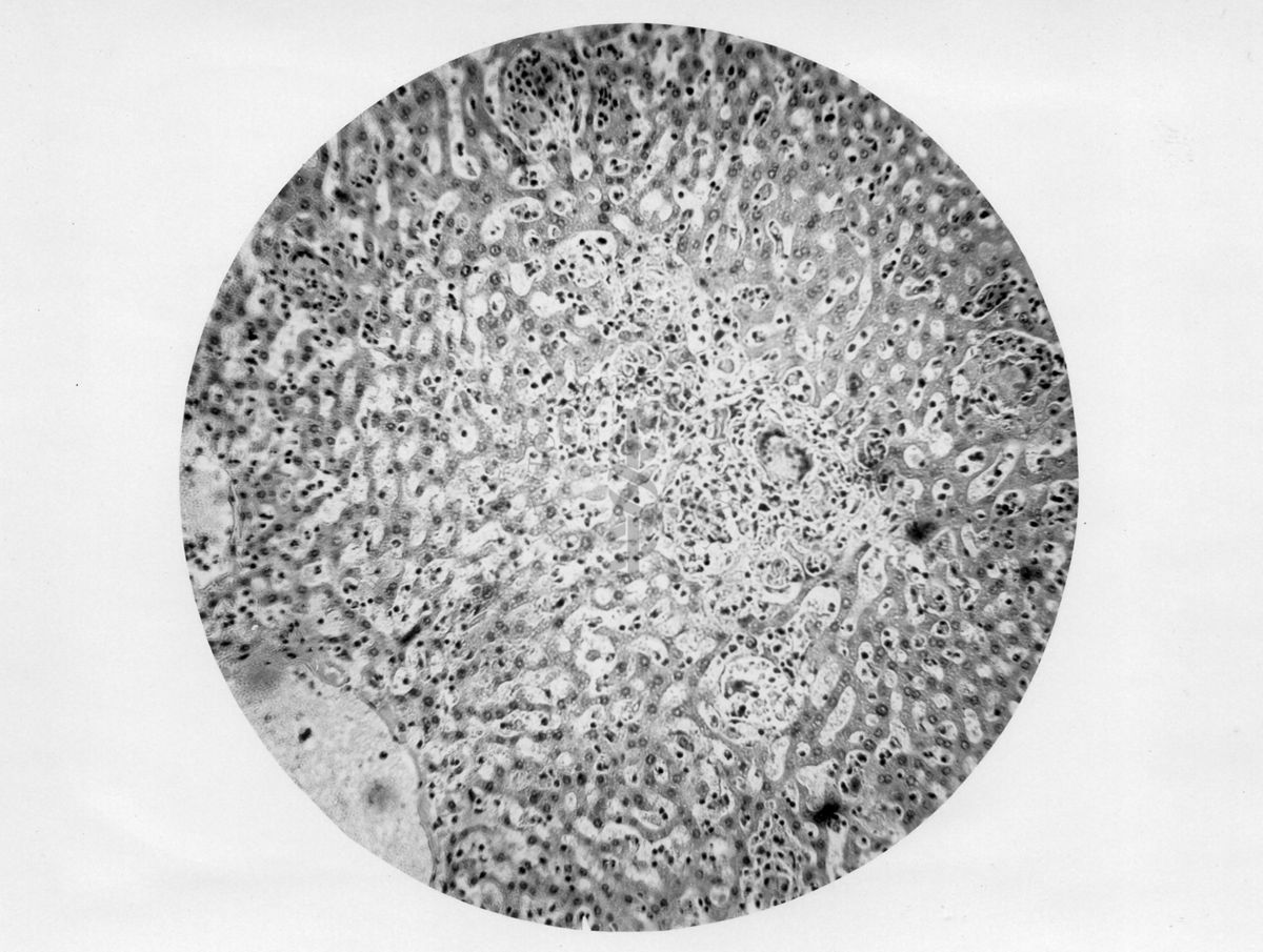 Micobatteri (Battaglini) Fegato-infiltrati granulomatosi - micro fotografia originale ingr. 110