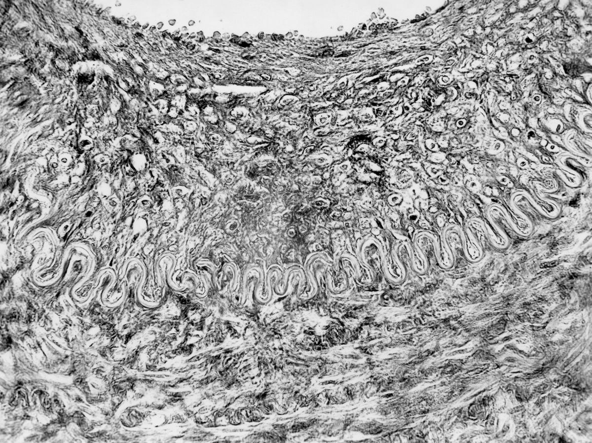 Comportamento delle pareti arteriose di fronte a sostanze irritanti per la cura degli aneurismi - microfotografia fotografia originale 400 ingr.