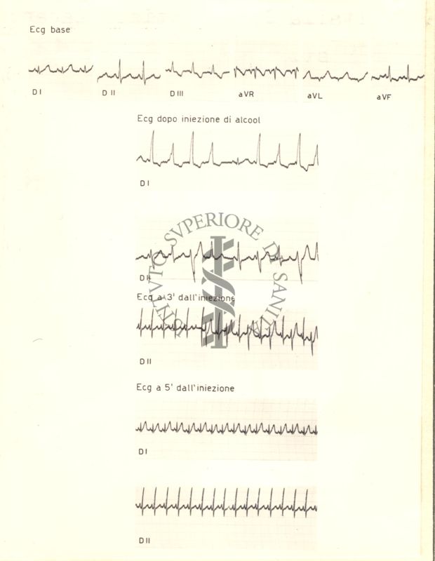 Tracciati di elettrocardiogramma che mostrano l'azione dell'alcol etilico sul cuore di coniglio, 3 e 5 minuti dopo l'iniezione