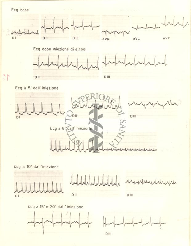 Tracciati di elettrocardiogramma che mostrano l'azione dell'alcol etilico sul cuore di coniglio, 5, 8, 10, 15 e 20 minuti dopo l'iniezione