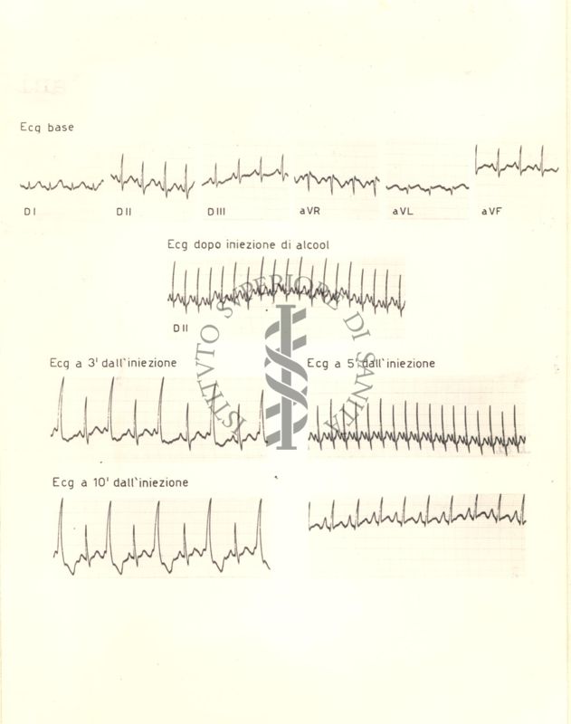 Tracciati di elettrocardiogramma che mostrano l'azione dell'alcol etilico sul cuore di coniglio, 3, 5 e 10 minuti dopo l'iniezione