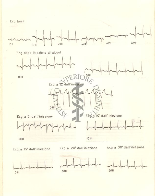 Tracciati di elettrocardiogramma che mostrano l'azione dell'alcol etilico sul cuore di coniglio, 2, 5, 10, 15, 20 e 30 minuti dopo l'iniezione