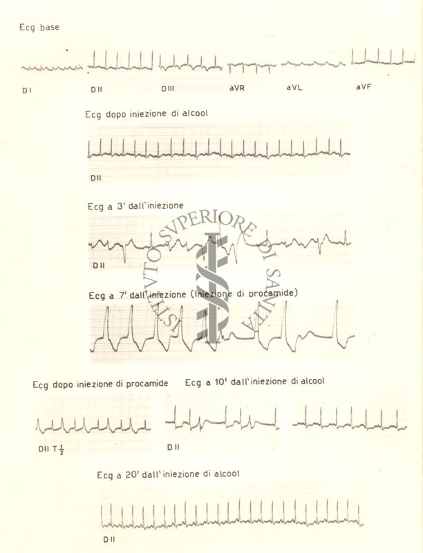 Tracciati elettrocardiografici del cuore di coniglio dopo 3, 10 e 20 minuti dalla somministrazione di alcol e dopo 7 minuti dalla somministrazione di procamide