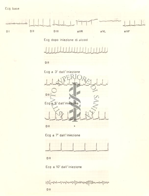 Tracciati elettrocardiografici del cuore di coniglio dopo 3, 5, 7 e 10 e 20 minuti dalla somministrazione di alcol