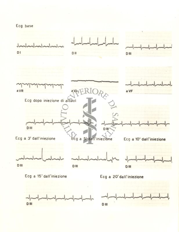 Tracciati elettrocardiografici del cuore di coniglio dopo 3, 5, 10, 15 e 20 minuti dalla somministrazione di alcol