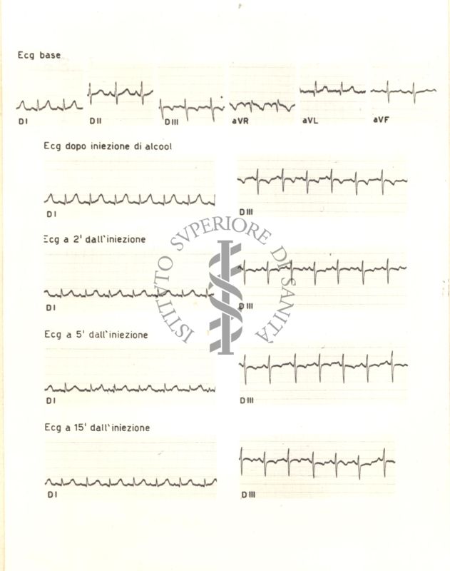 Tracciati elettrocardiografici del cuore di coniglio dopo 2, 5, e 15 minuti dalla somministrazione di alcol