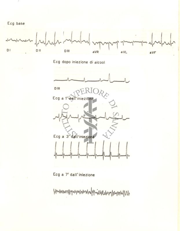 Tracciati elettrocardiografici del cuore di coniglio dopo 1, 3, e 7 minuti dalla somministrazione di alcol