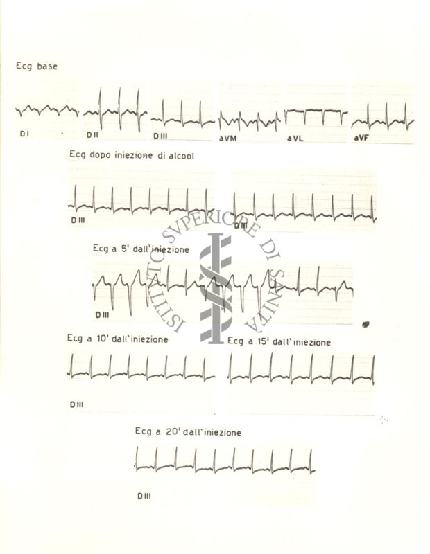 Tracciati elettrocardiografici del cuore di coniglio dopo 5, 10, 15 e 20 minuti dalla somministrazione di alcol