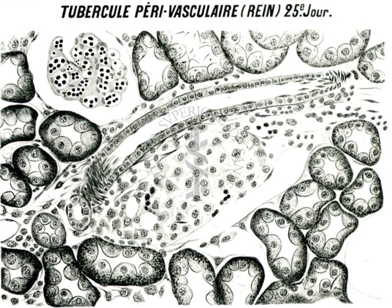 Tubercolo peri - vascolare nel rene