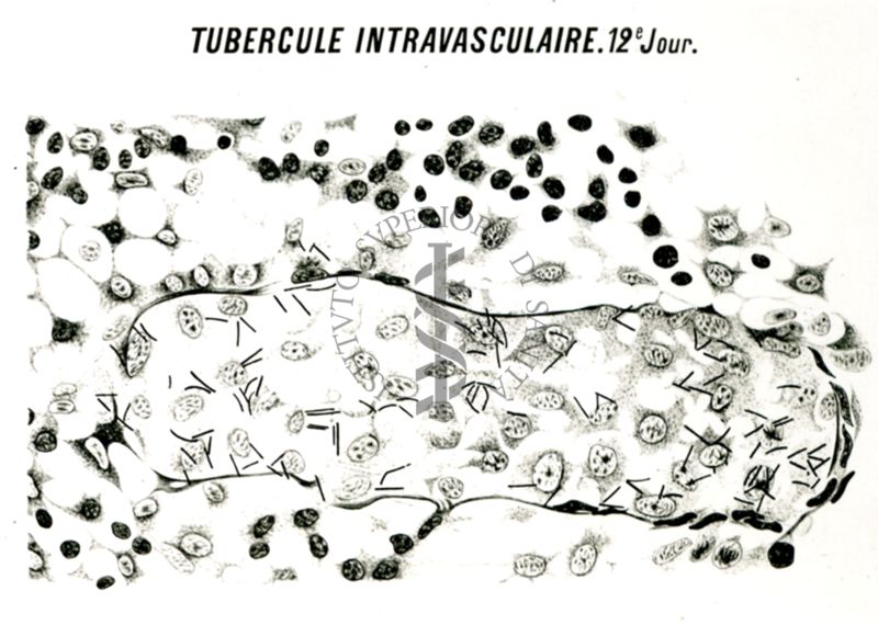 Tubercolosi intravascolare