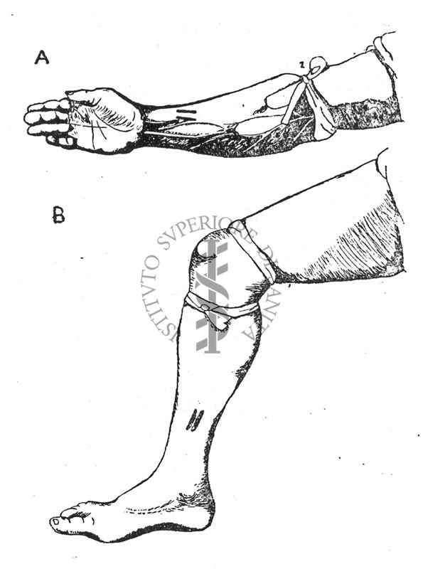 Legatura di arti morsicati da serpenti A) braccio - B) gamba