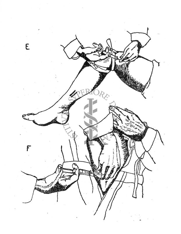 Tecnica di iniezione locale antiofidica E) cosce - F) braccio