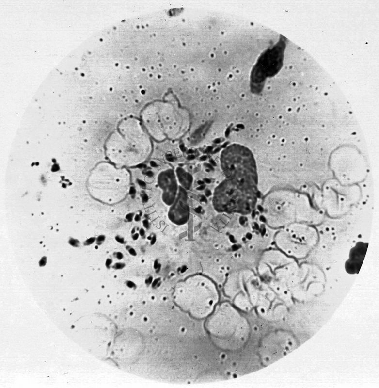 Leishmania tropica nel bottone d'oriente umano (Abruzzi)