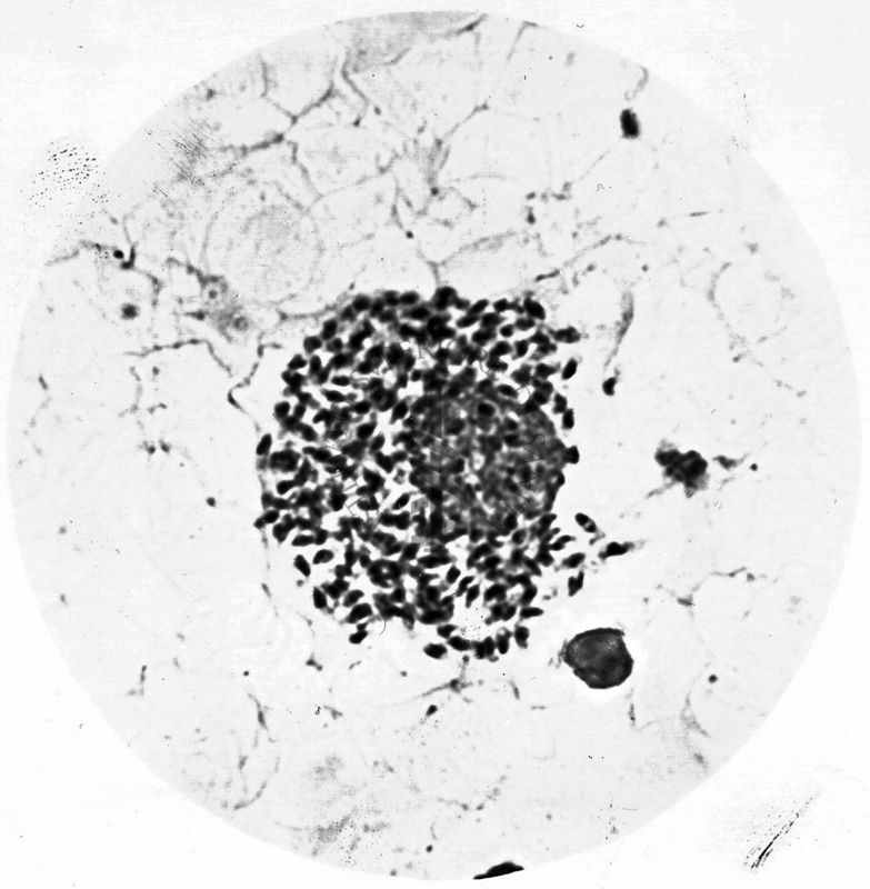 Leishmania tropica-Leishmanie libere e nel citoplasma di cellule reticolo endoteliali (lesione cutanea umana) Abruzzi