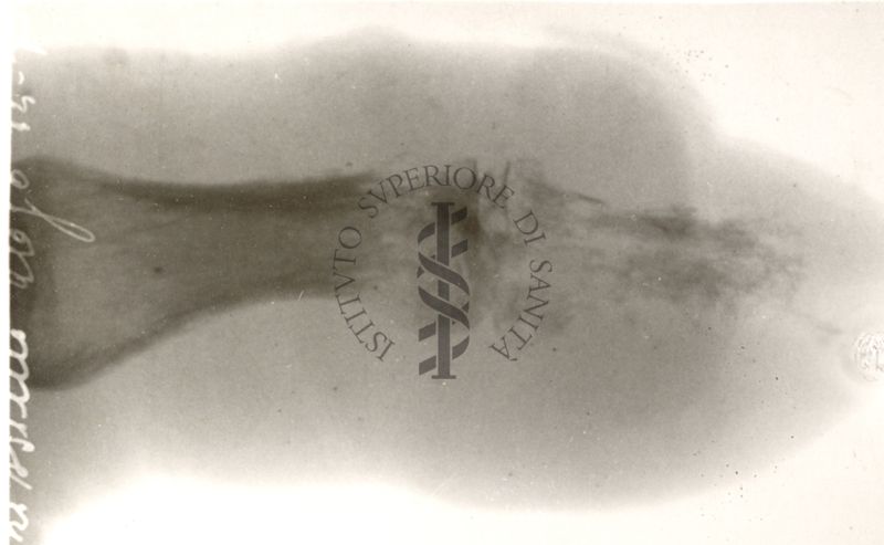 Radiografia del dito pollice della mano sinistra affetto da notevole atrofia lacunare diffusa con zona ossea iperopaca riferibile a sequestro. (Osteomielite)