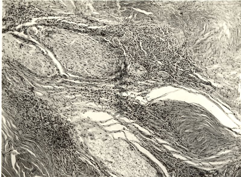 Neurofibroma