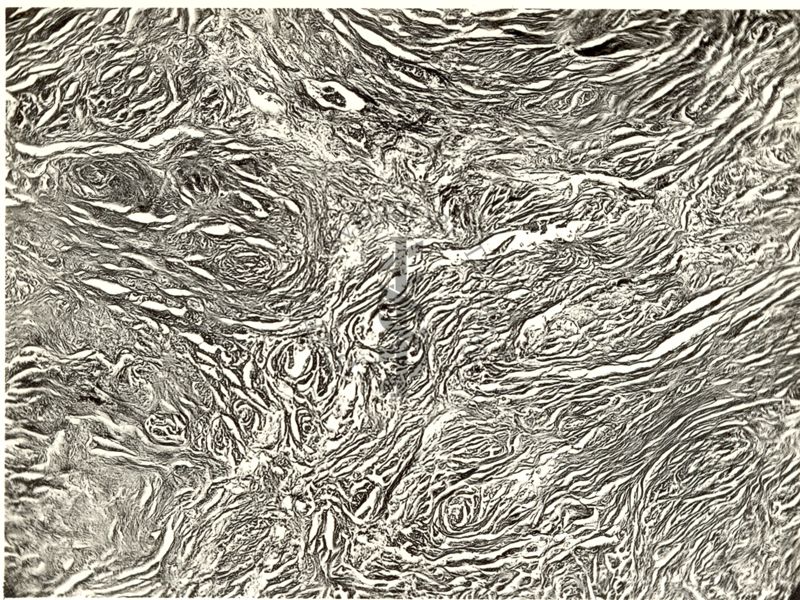 Neurofibroma