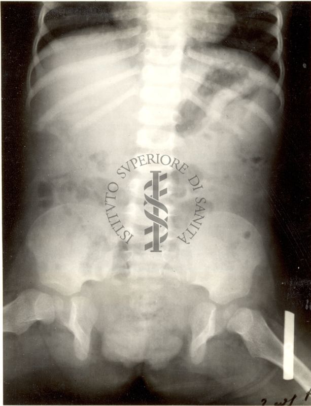 Maltoformazione embrionaria (Estrofia vescicale totale).