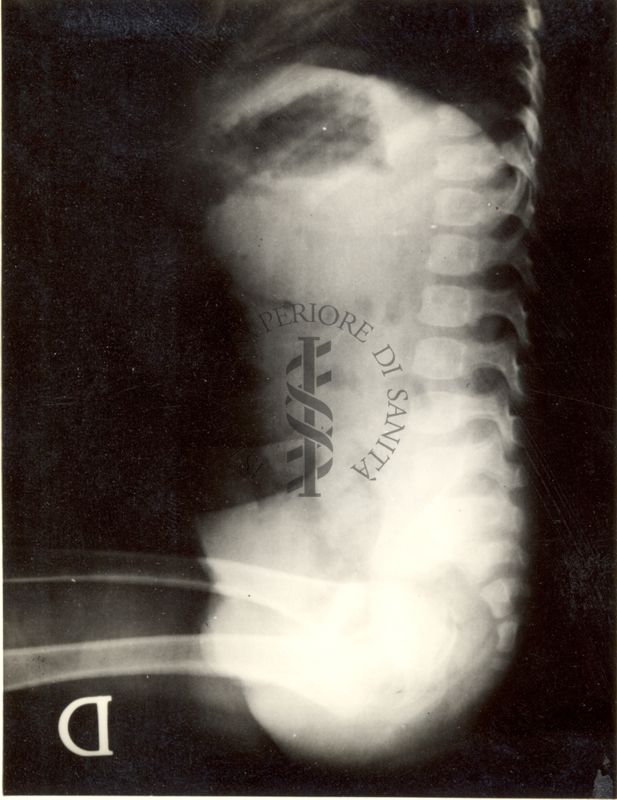 Maltoformazione embrionaria (Estrofia vescicale totale).