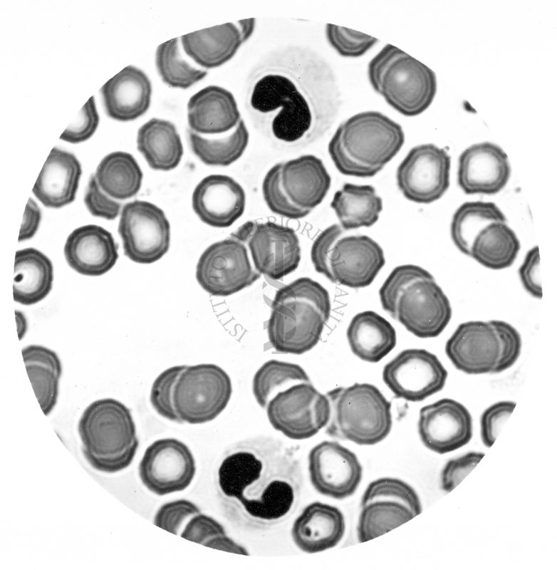 Processo di segmentazione dei metamielociti neutrofili - Anomalia di Pelger - Hùet